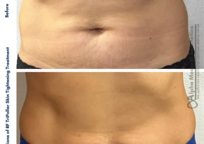 Alpha Medical Aesthetics RF TriPollar Skin Tightening Facial Treatment By Dr. Sassan Kaveh Red Rock Country Club Las Vegas 315