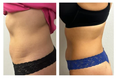 Alpha Medical Aesthetics RF TriPollar Skin Tightening Facial Treatment By Dr. Sassan Kaveh Southern Highlands Las Vegas 314