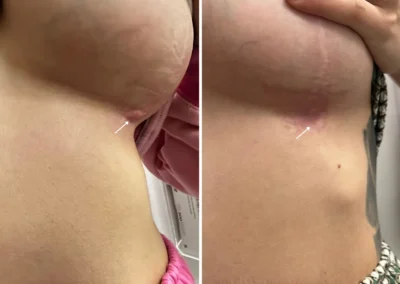 Alpha Medical Aesthetics Scar Removal and Revision Breast Treatment By Dr. Sassan Kaveh Downtown Las Vegas 103