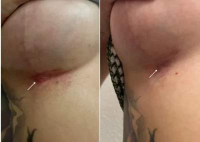 Alpha Medical Aesthetics Scar Removal and Revision Breast Treatment By Dr. Sassan Kaveh Southern Highlands Las Vegas 084