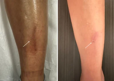 Alpha Medical Aesthetics Scar Removal and Revision Facial Treatment By Dr. Sassan Kaveh Canyon Gate Las Vegas 102