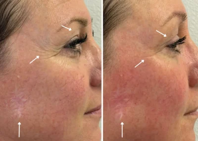 Alpha Medical Aesthetics Scar Removal and Revision Facial Treatment By Dr. Sassan Kaveh Southern Highlands Las Vegas 246