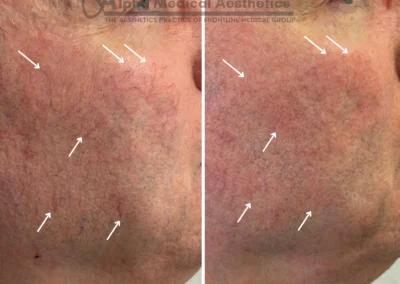 Alpha Medical Aesthetics SplendorX Laser Vein Removal Facial Treatment By Dr. Sassan Kaveh Centennial Hills Las Vegas 173