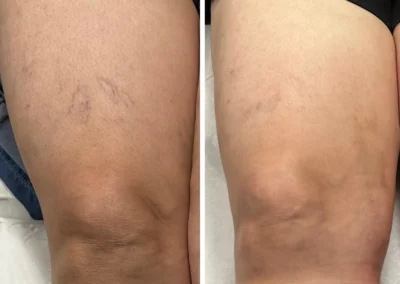 Alpha Medical Aesthetics SplendorX Laser Vein Removal Facial Treatment By Dr. Sassan Kaveh Henderson Las Vegas 115
