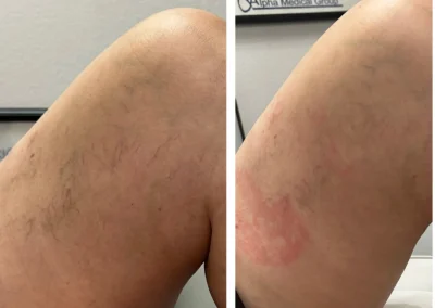 Alpha Medical Aesthetics SplendorX Laser Vein Removal Facial Treatment By Dr. Sassan Kaveh Mountains Edge Las Vegas 116