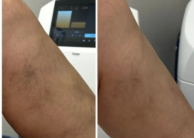 Alpha Medical Aesthetics SplendorX Laser Vein Removal Facial Treatment By Dr. Sassan Kaveh Southern Highlands Las Vegas 117
