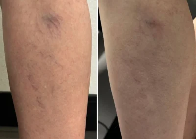 Alpha Medical Aesthetics SplendorX Laser Vein Removal Facial Treatment By Dr. Sassan Kaveh Spanish Trail Las Vegas 114
