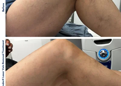 Alpha Medical Aesthetics SplendorX Laser Vein Removal Facial Treatment By Dr. Sassan Kaveh The Lakes Las Vegas 118