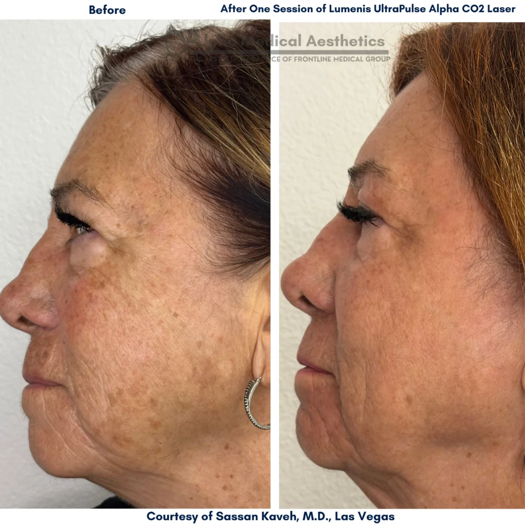 Alpha Medical Aesthetics UltraPulse Alpha CO2 Laser 1 Session By Dr Sassan Kaveh Las Vegas Before After Alpha Medical Aesthetics UltraPulse Alpha CO2 Laser 1 Session By Dr Sassan Kaveh Las Vegas Before After