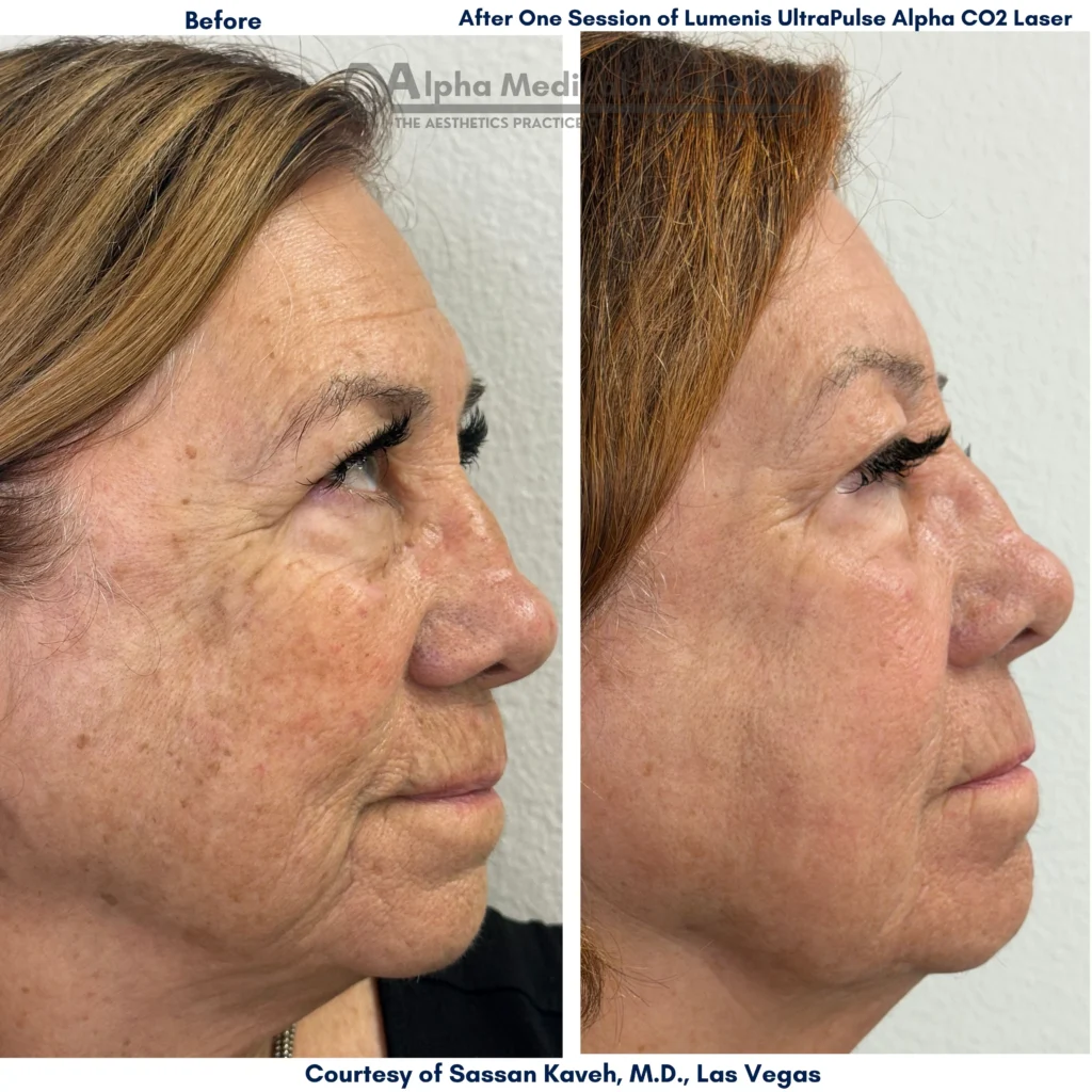Alpha Medical Aesthetics UltraPulse Alpha CO2 Laser 1 Session By Dr Sassan Kaveh Las Vegas Before After2 Alpha Medical Aesthetics UltraPulse Alpha CO2 Laser 1 Session By Dr Sassan Kaveh Las Vegas Before After2