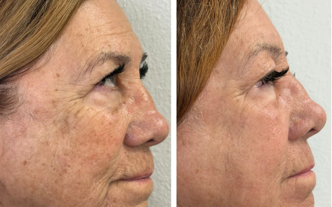 Why Fall Is the Best Time for Laser Skin Resurfacing in Las Vegas
