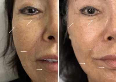 Alpha Medical Aesthetics triGLO IPL and triLift Facial Treatment By Dr. Sassan Kaveh Centennial Hills Las Vegas 106