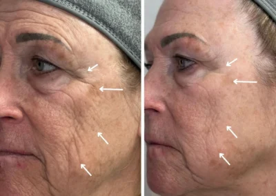 Alpha Medical Aesthetics triGLO IPL and triLift Facial Treatment By Dr. Sassan Kaveh Downtown Las Vegas 001