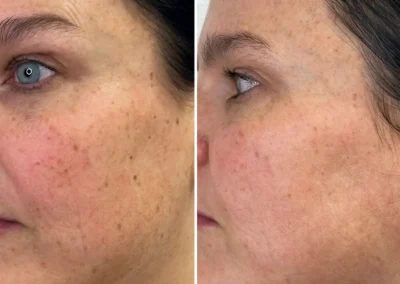 Alpha Medical Aesthetics triGLO IPL and triLift Facial Treatment By Dr. Sassan Kaveh Green Valley Ranch Las Vegas 056