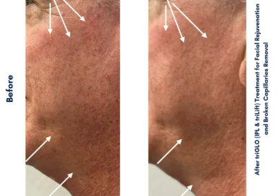 Alpha Medical Aesthetics triGLO IPL and triLift Facial Treatment By Dr. Sassan Kaveh MacDonald Highlands Las Vegas 109