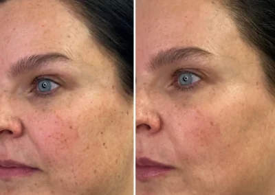 Alpha Medical Aesthetics triGLO IPL and triLift Facial Treatment By Dr. Sassan Kaveh Peccole Ranch Las Vegas 058
