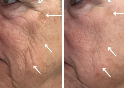 Alpha Medical Aesthetics triGLO IPL and triLift Facial Treatment By Dr. Sassan Kaveh Red Rock Country Club Las Vegas 002