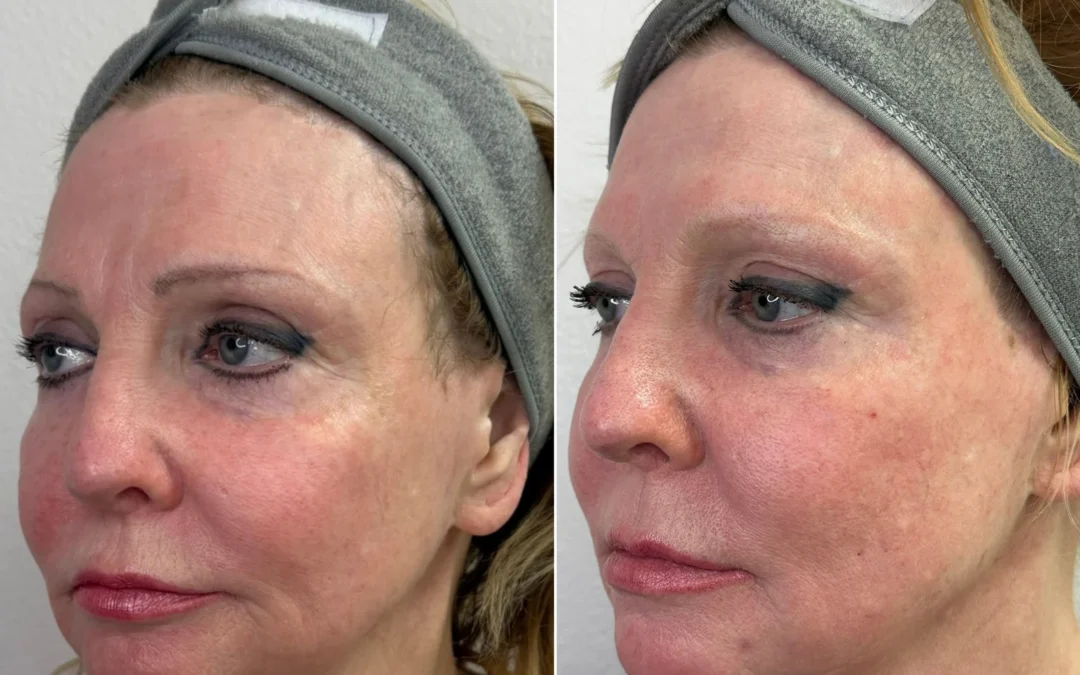 Holiday-Ready Jawline: Non-Surgical Jawline Lifting with TriLift in Las Vegas
