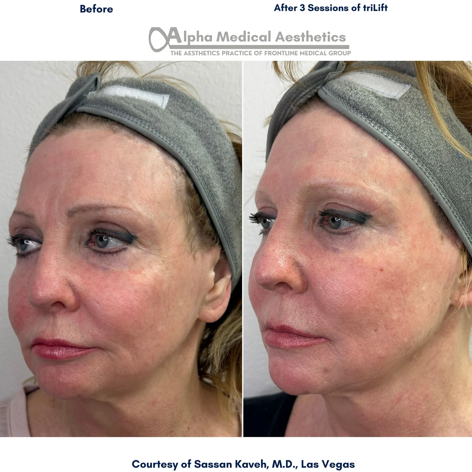 non-surgical jawline lift in Las Vegas