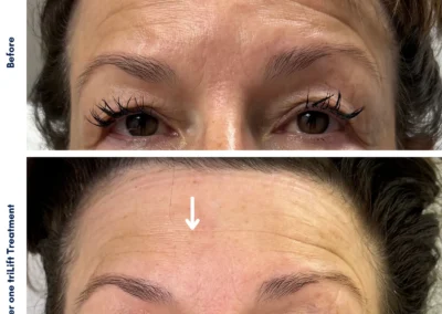 Alpha Medical Aesthetics triLift by Lumenis Facial Treatment By Dr. Sassan Kaveh Centennial Hills Las Vegas 113
