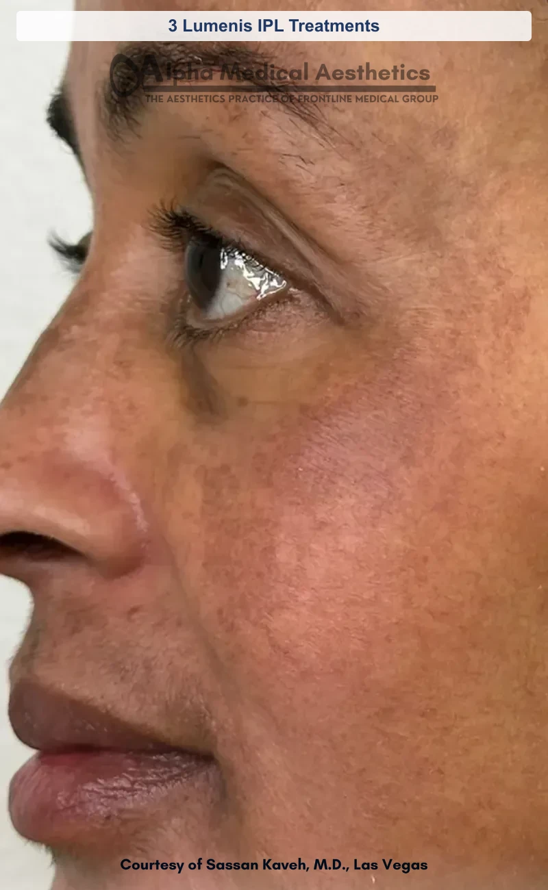 3 Lumenis IPL Treatments before and after in Las Vegas by Dr. Sassan Kaveh (After)