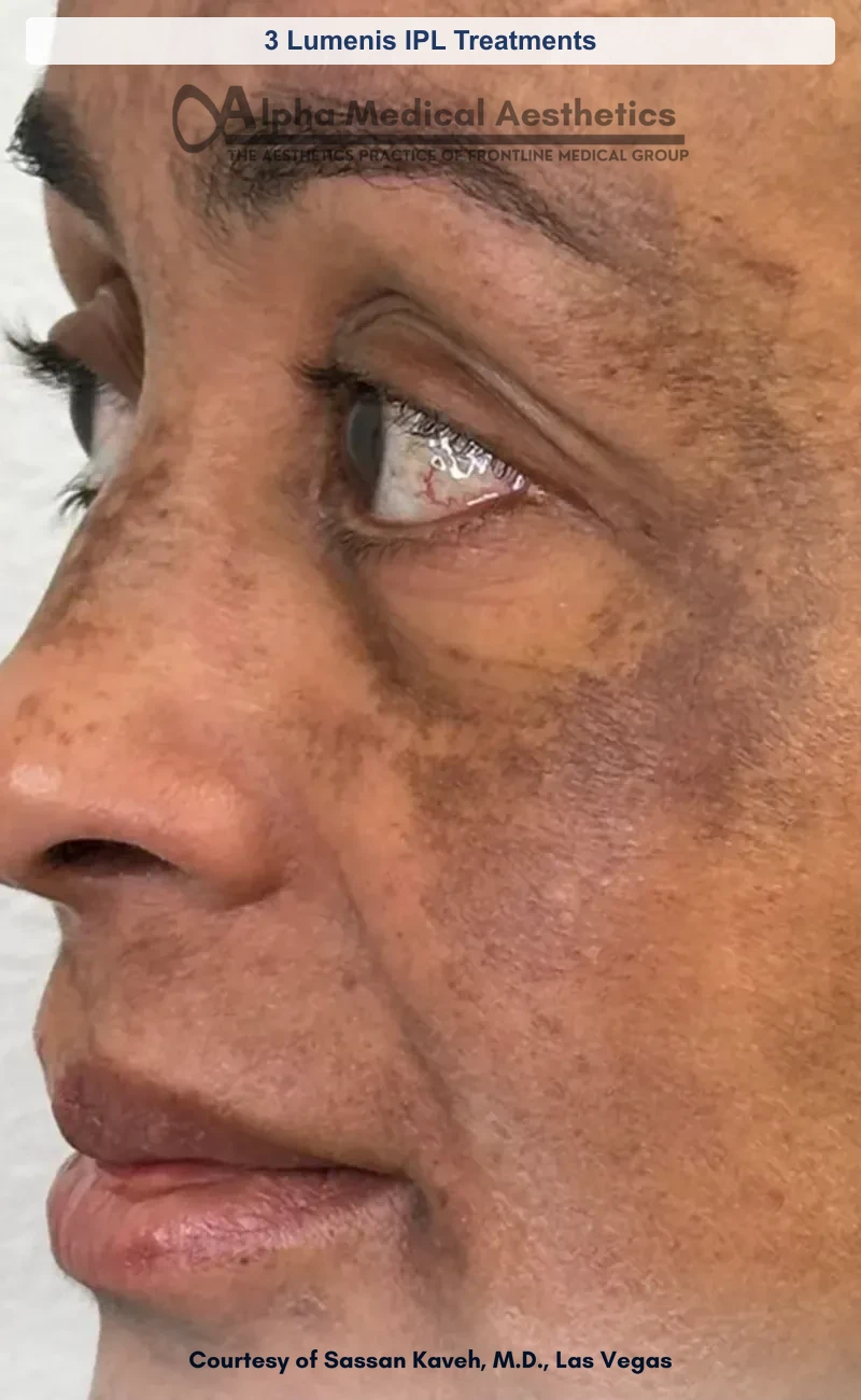 3 Lumenis IPL Treatments before and after in Las Vegas by Dr. Sassan Kaveh (Before)