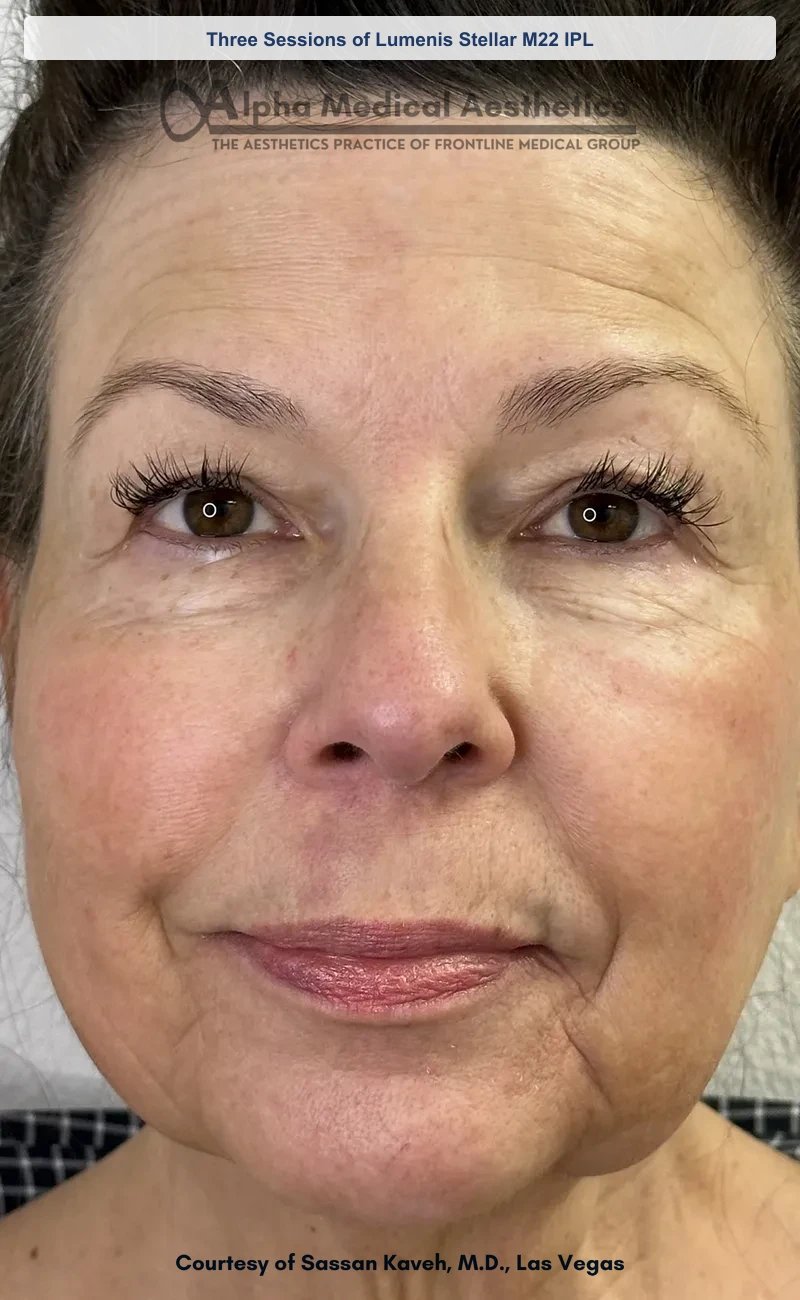 Three Sessions of Lumenis Stellar M22 IPL before and after in Las Vegas by Dr. Sassan Kaveh (After)