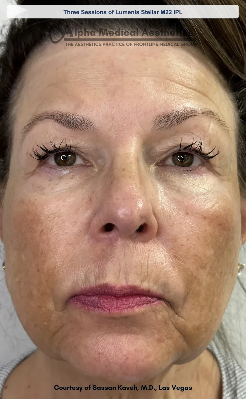 Three Sessions of Lumenis Stellar M22 IPL before and after in Las Vegas by Dr. Sassan Kaveh (Before)