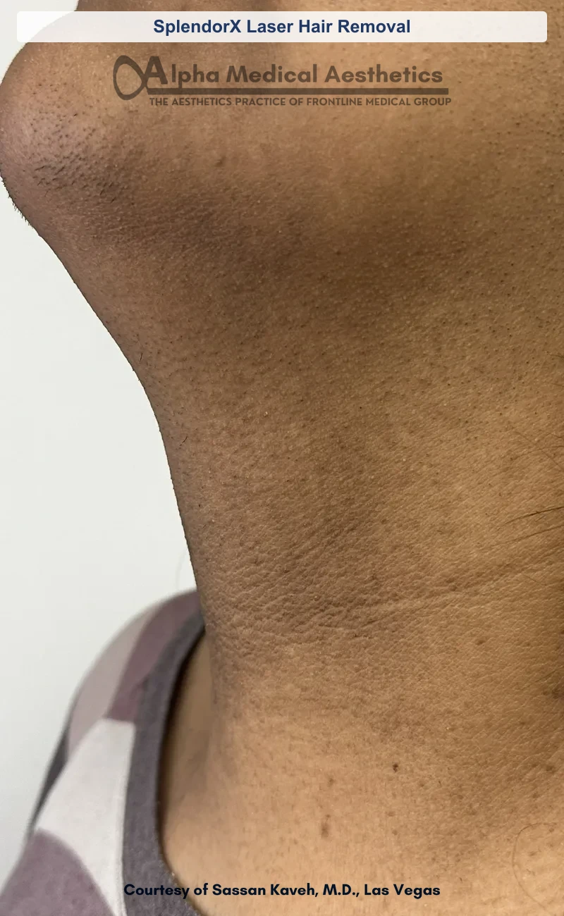 SplendorX laser chin and neck hair removal before and after in Las Vegas by Dr. Sassan Kaveh (After)