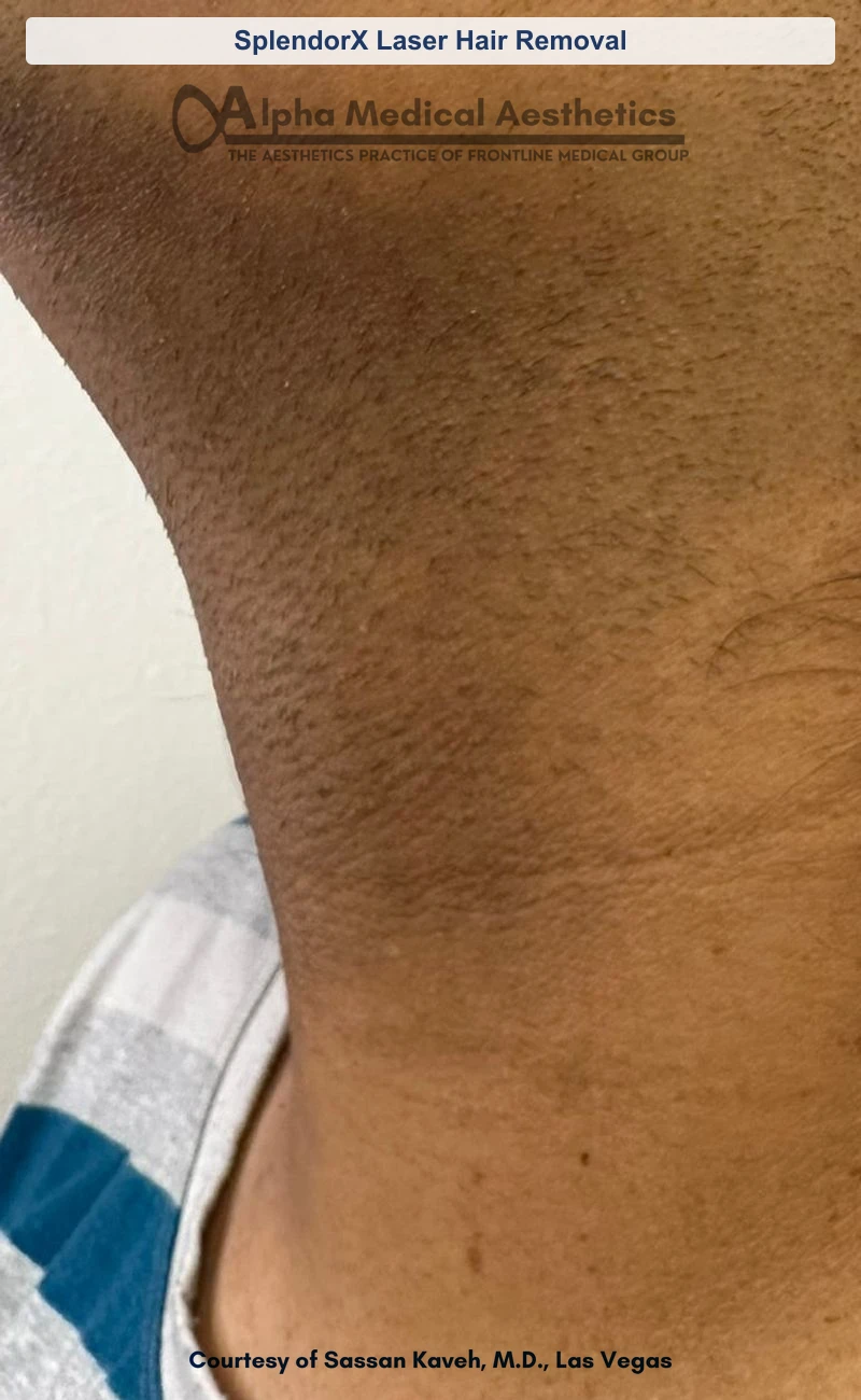 SplendorX laser chin and neck hair removal before and after in Las Vegas by Dr. Sassan Kaveh (Before)
