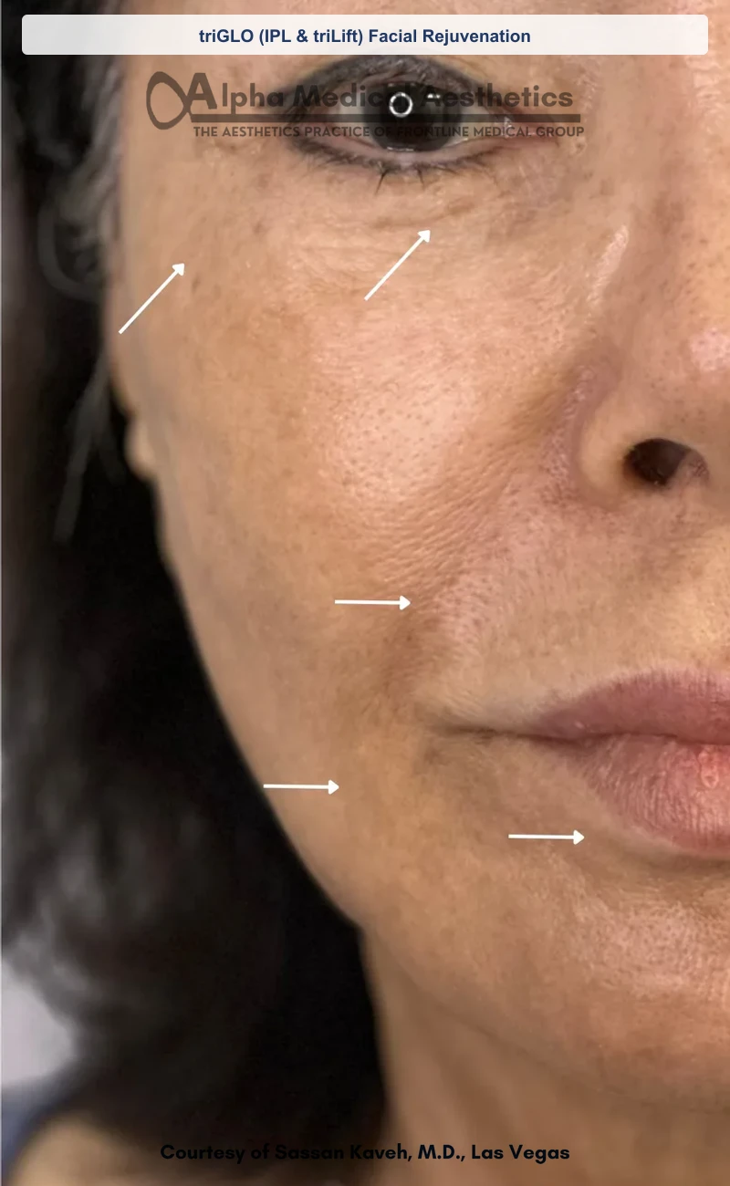 triGLO (IPL & triLift) Facial Rejuvenation before and after in Las Vegas by Dr. Sassan Kaveh (After)