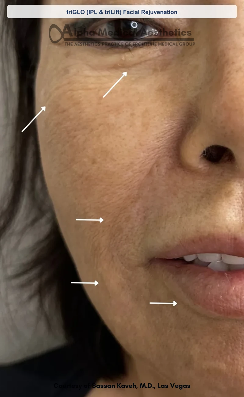 triGLO (IPL & triLift) Facial Rejuvenation before and after in Las Vegas by Dr. Sassan Kaveh (Before)
