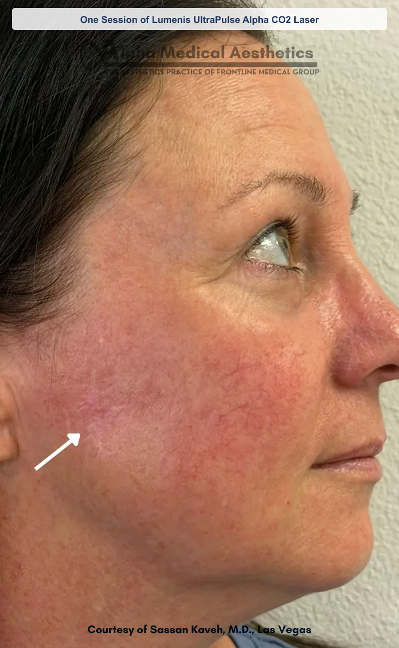 One Session of Lumenis UltraPulse Alpha CO2 Laser before and after in Las Vegas by Dr. Sassan Kaveh (After)