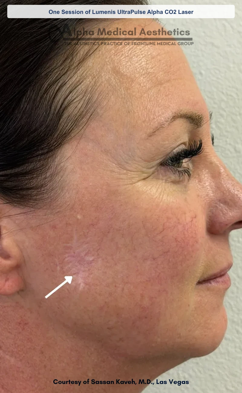 One Session of Lumenis UltraPulse Alpha CO2 Laser before and after in Las Vegas by Dr. Sassan Kaveh (Before)