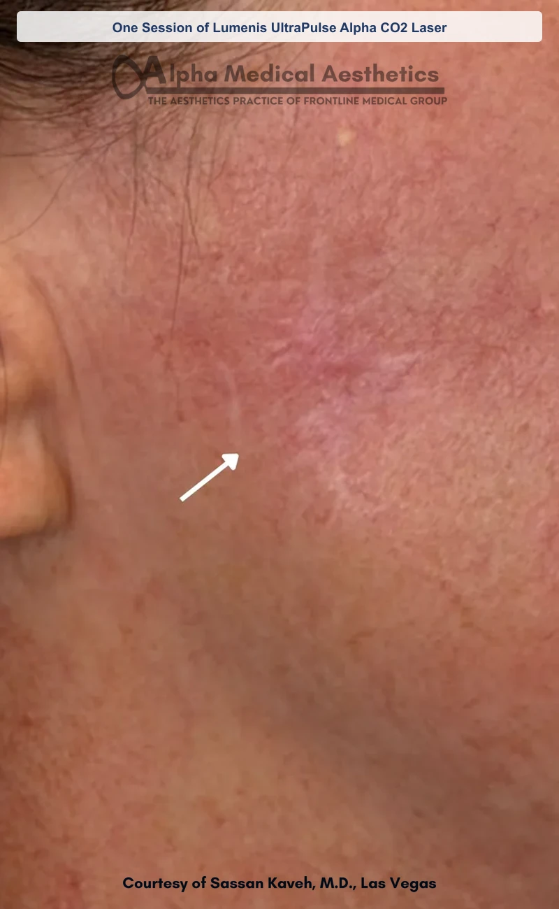One Session of Lumenis UltraPulse Alpha CO2 Laser before and after in Las Vegas by Dr. Sassan Kaveh (After)