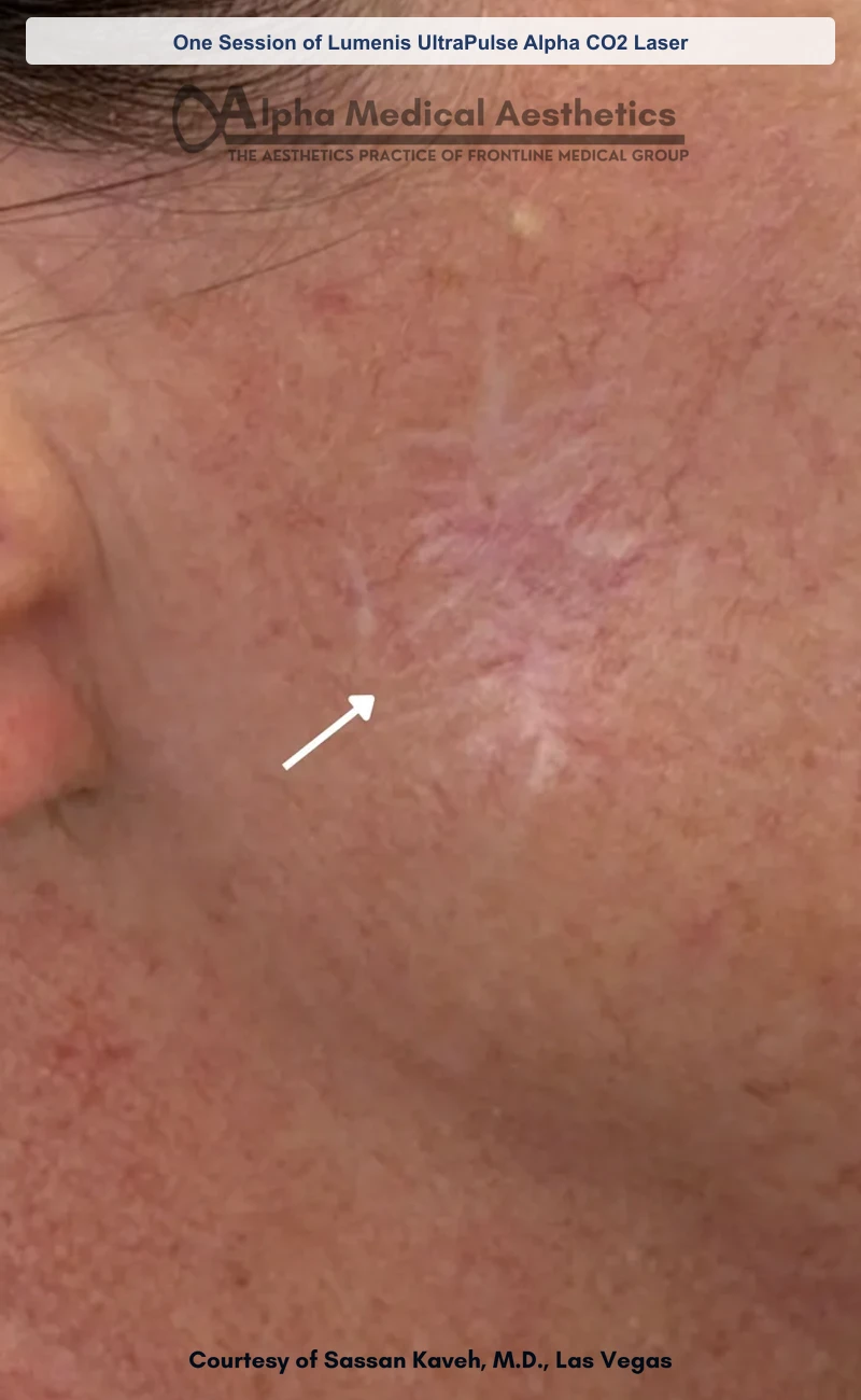 One Session of Lumenis UltraPulse Alpha CO2 Laser before and after in Las Vegas by Dr. Sassan Kaveh (Before)