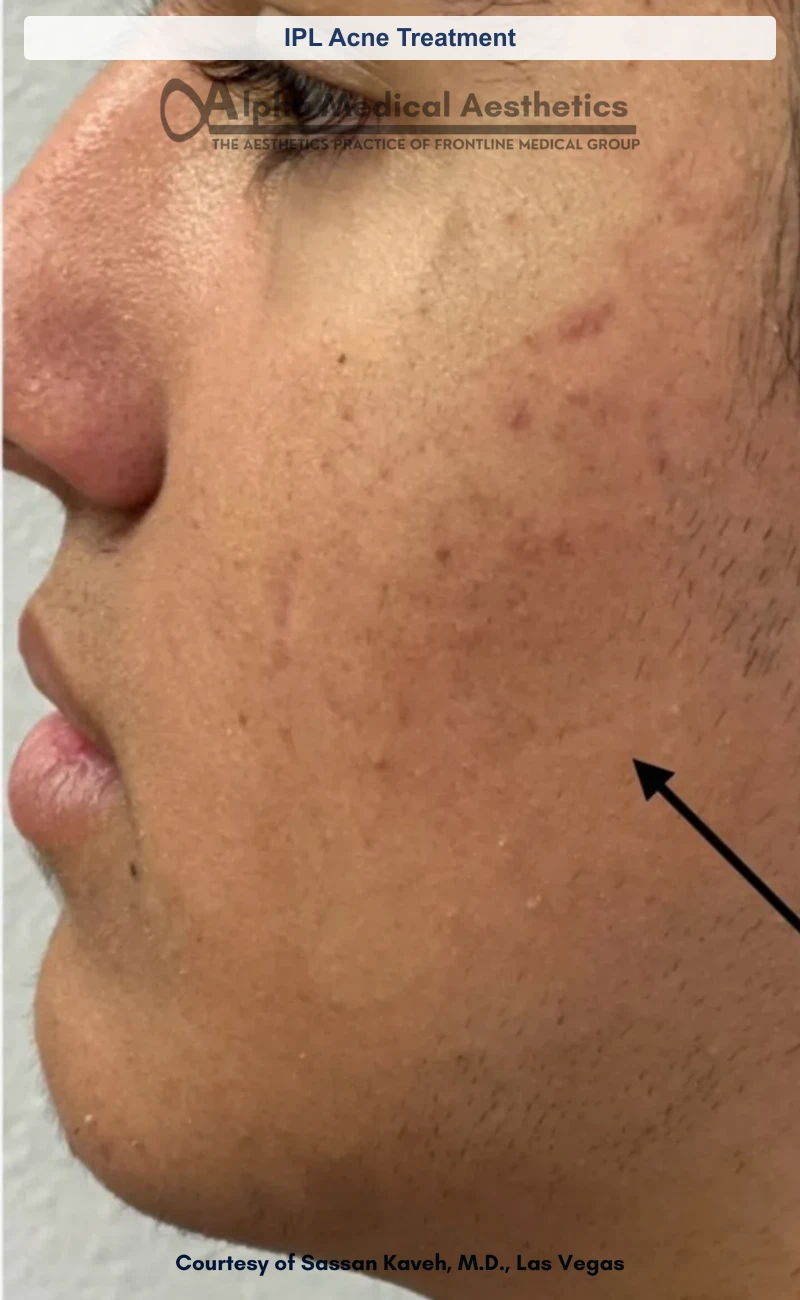IPL Acne Treatment before and after in Las Vegas by Dr. Sassan Kaveh (After)