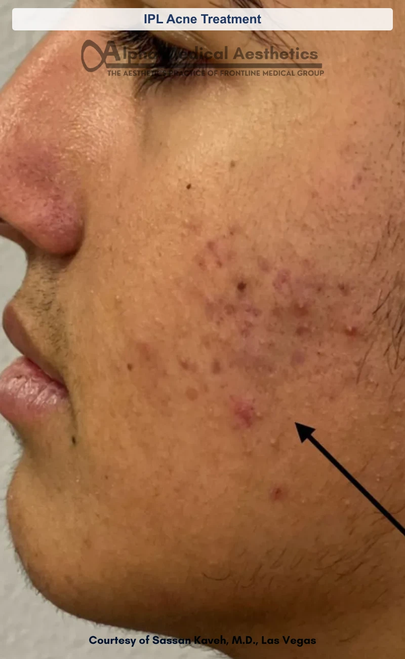 IPL Acne Treatment before and after in Las Vegas by Dr. Sassan Kaveh (Before)