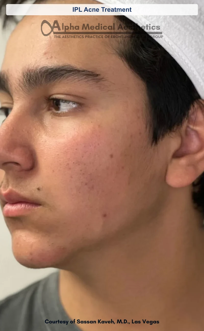 IPL Acne Treatment before and after in Las Vegas by Dr. Sassan Kaveh (After)