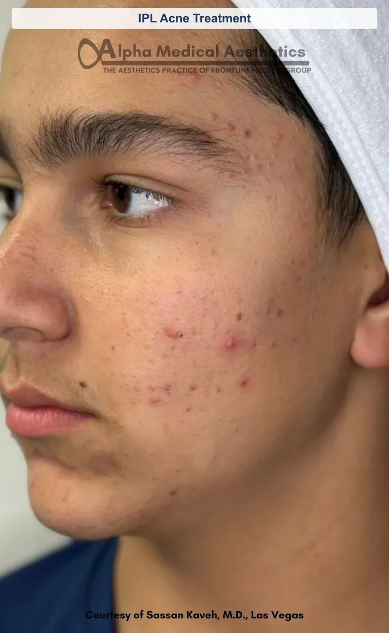 IPL Acne Treatment before and after in Las Vegas by Dr. Sassan Kaveh (Before)