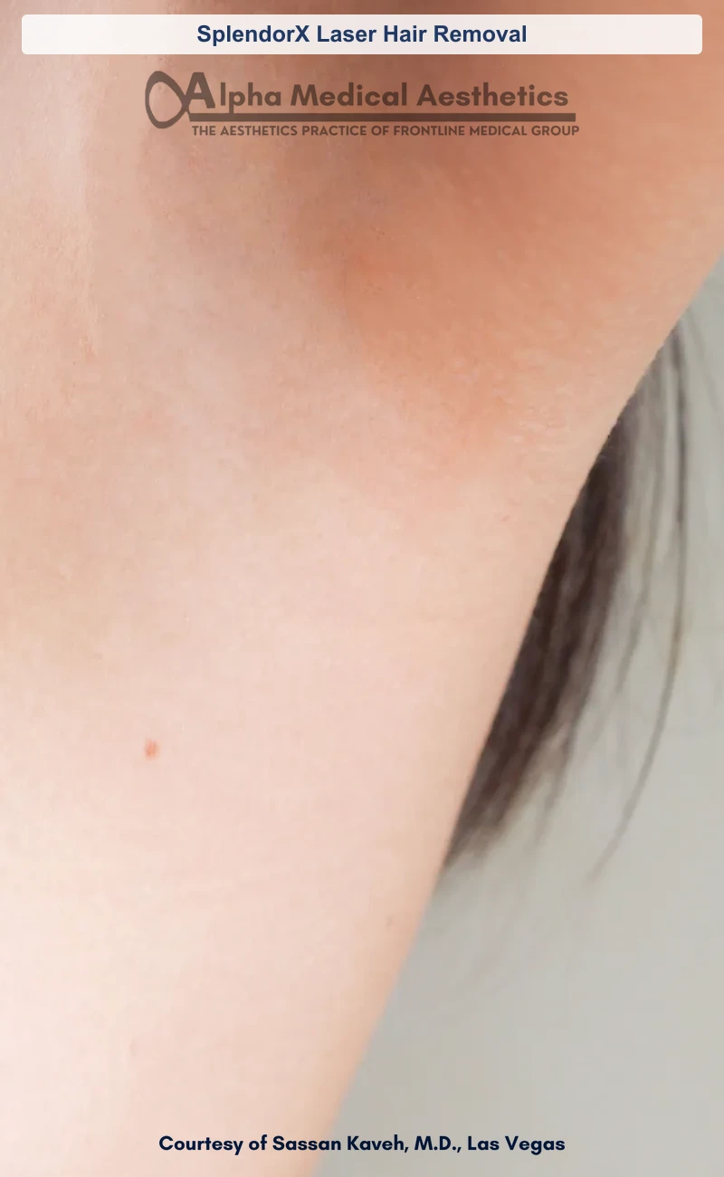 SplendorX Laser Hair Removal before and after in Las Vegas by Dr. Sassan Kaveh (After)