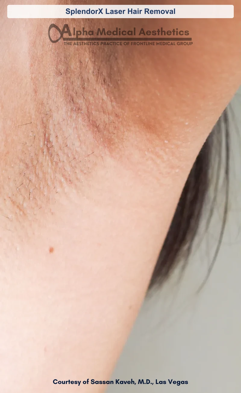 SplendorX Laser Hair Removal before and after in Las Vegas by Dr. Sassan Kaveh (Before)