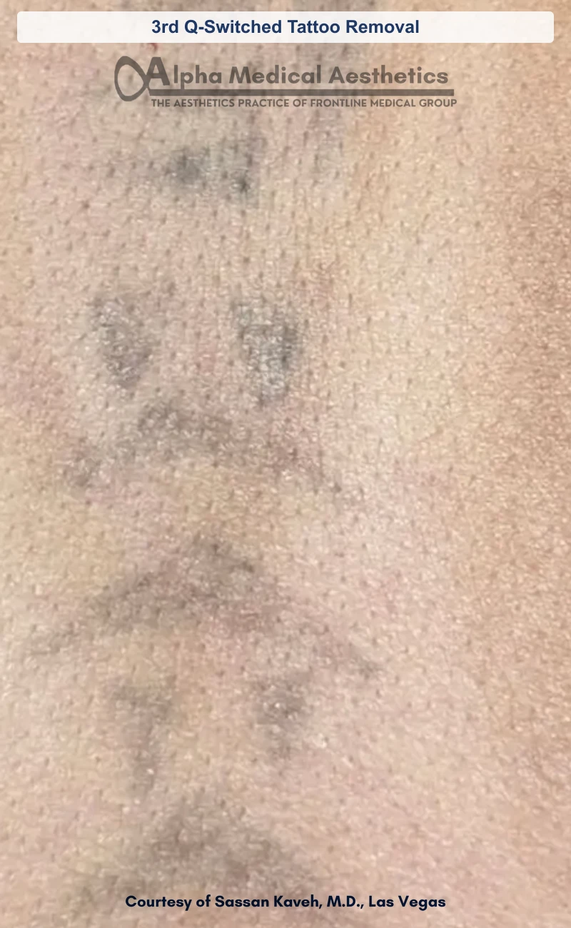 3rd Q-Switched Tattoo Removal before and after in Las Vegas by Dr. Sassan Kaveh (After)