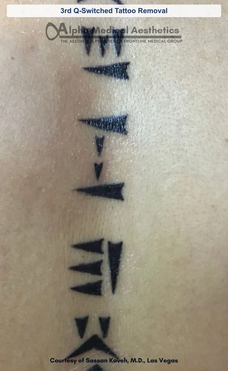 3rd Q-Switched Tattoo Removal before and after in Las Vegas by Dr. Sassan Kaveh (Before)