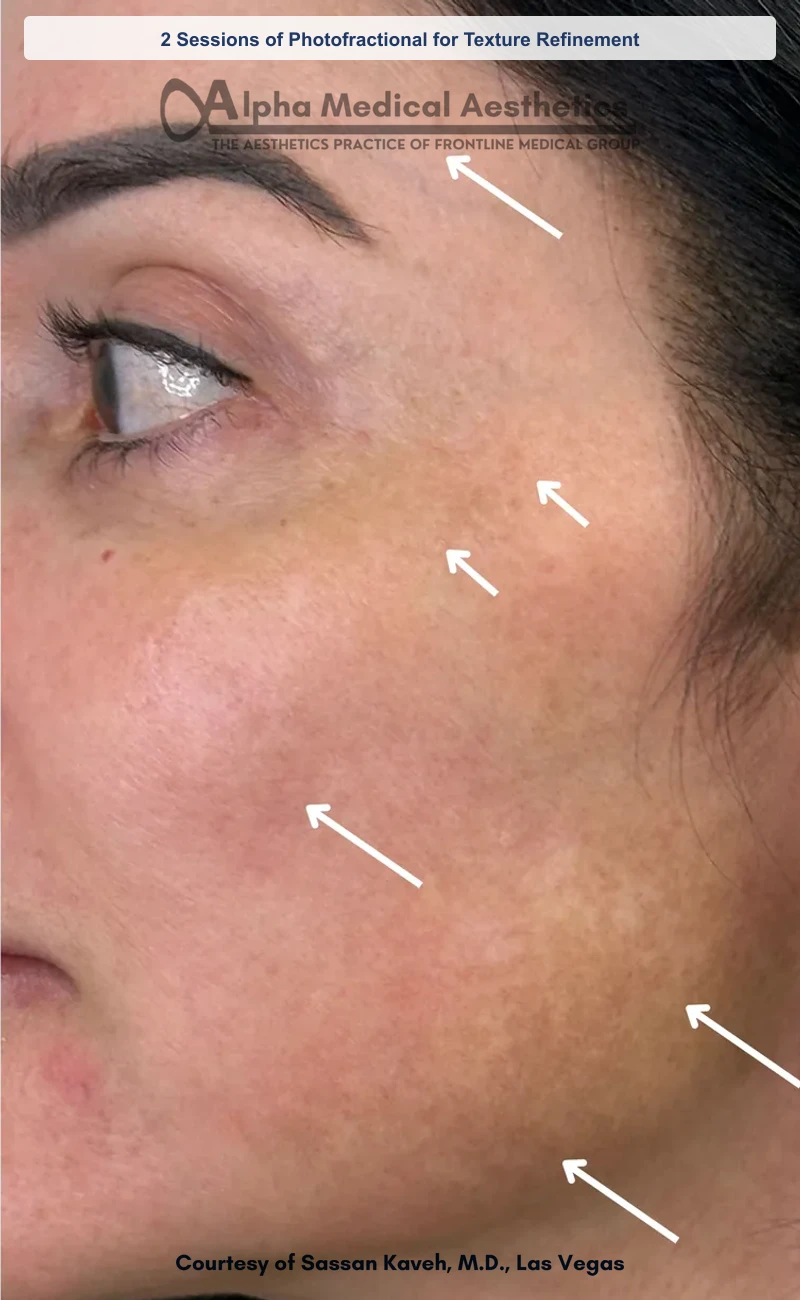 2 Sessions of Photofractional for Texture Refinement before and after in Las Vegas by Dr. Sassan Kaveh (After)