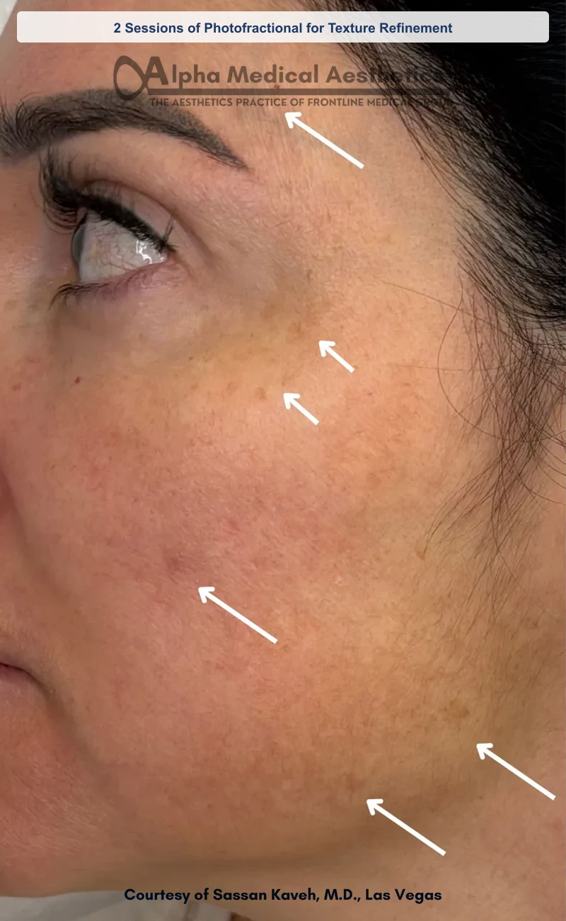 2 Sessions of Photofractional for Texture Refinement before and after in Las Vegas by Dr. Sassan Kaveh (Before)