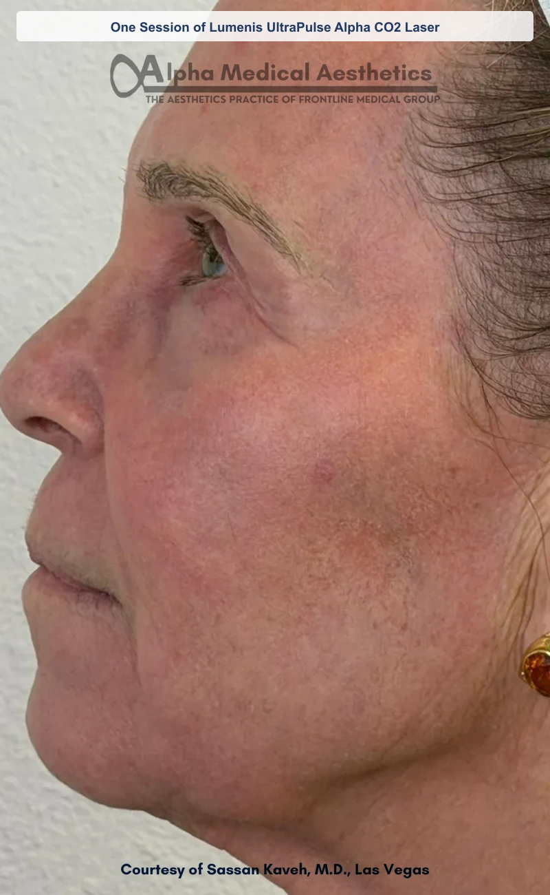 One Session of Lumenis UltraPulse Alpha CO2 Laser before and after in Las Vegas by Dr. Sassan Kaveh (After)