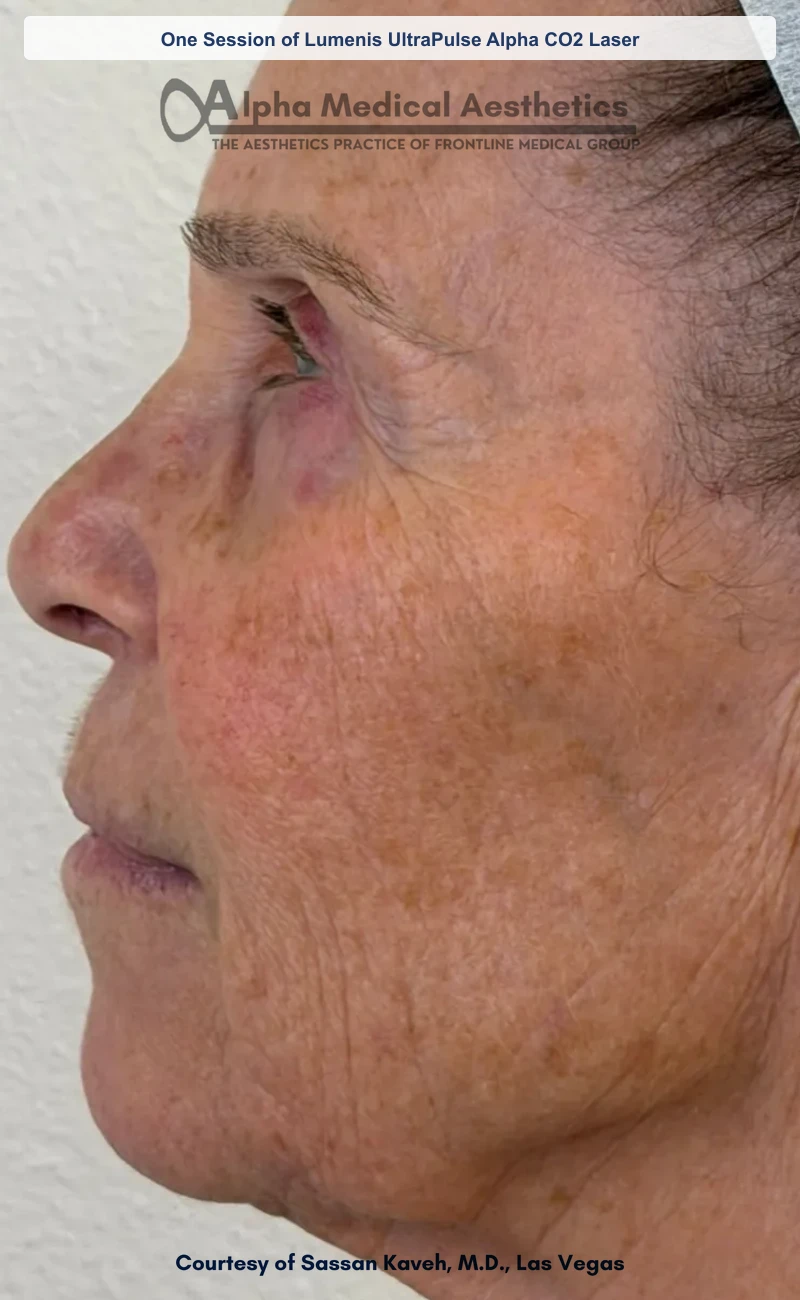 One Session of Lumenis UltraPulse Alpha CO2 Laser before and after in Las Vegas by Dr. Sassan Kaveh (Before)