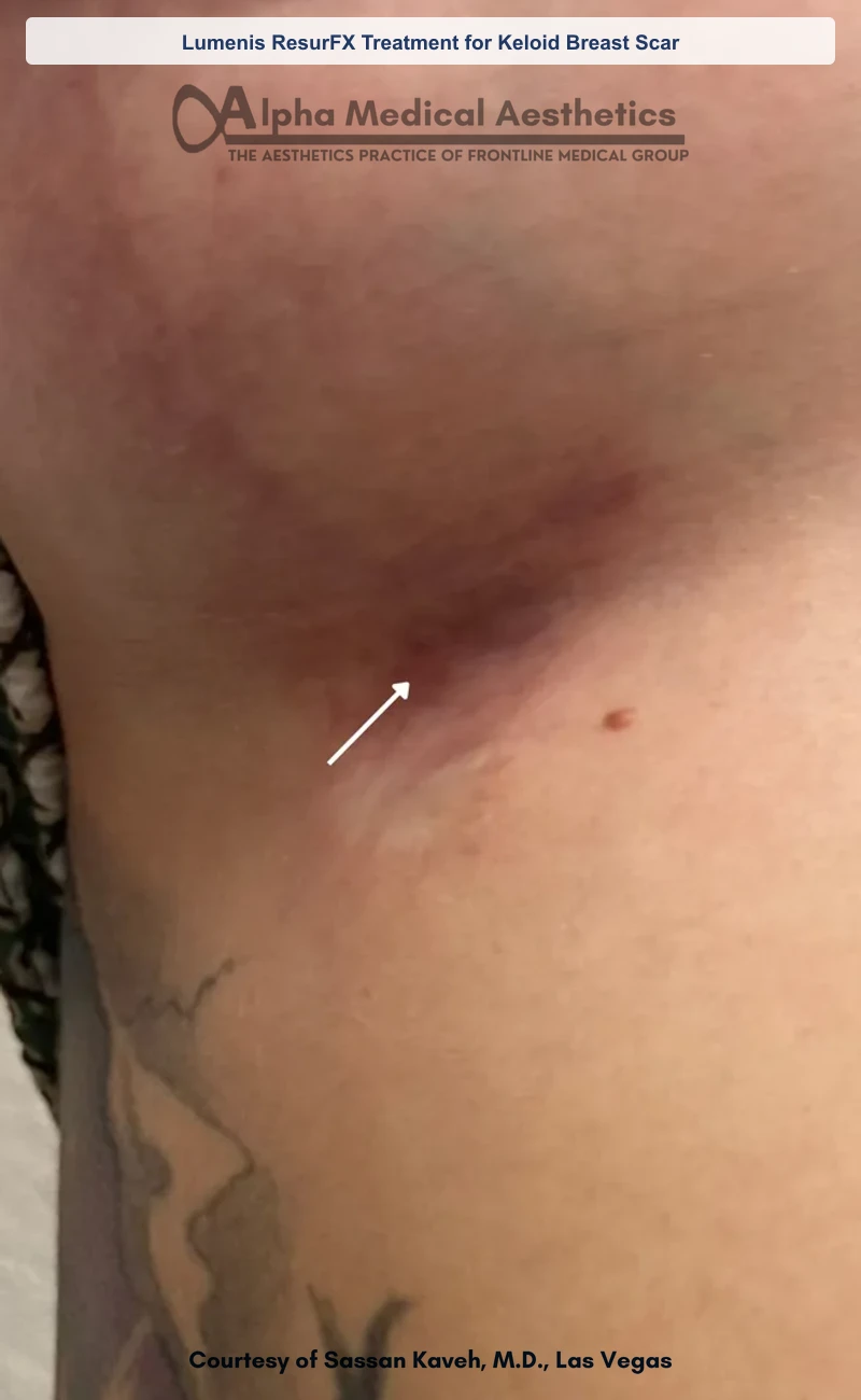Lumenis ResurFX Treatment for Keloid Breast Scar before and after in Las Vegas by Dr. Sassan Kaveh (After)
