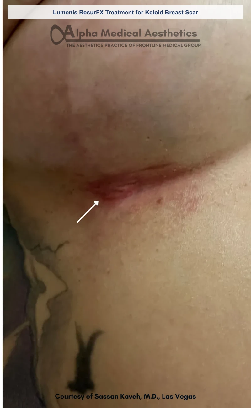 Lumenis ResurFX Treatment for Keloid Breast Scar before and after in Las Vegas by Dr. Sassan Kaveh (Before)